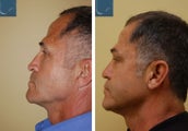 Revision Rhinoplasty