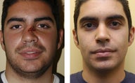 Revision rhinoplasty