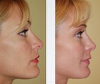 Revision rhinoplasty