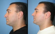 male rhinoplasty