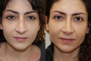 Revision Rhinoplasty Surgery. 1 year post-op.