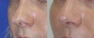Revision Rhinoplasty