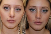 Revision Rhinoplasty. 6-months post-op.