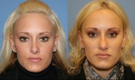 Revision Rhinoplasty