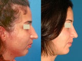 Rhinoplasty