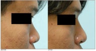 Asian Rhinoplasty