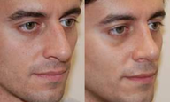 Rhinoplasty 6 weeks post-op. 