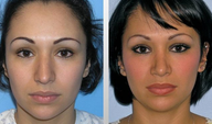 Rhinoplasty