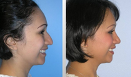 Rhinoplasty