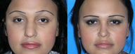 Rhinoplasty