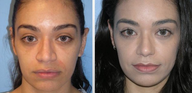Rhinoplasty