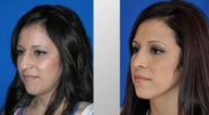 Rhinoplasty