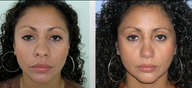 Rhinoplasty