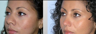 Rhinoplasty