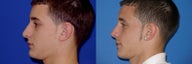 Rhinoplasty