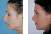 Rhinoplasty
