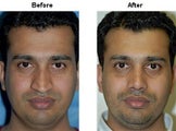 Rhinoplasty