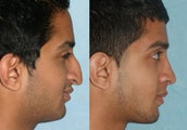 Rhinoplasty