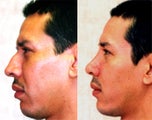 Rhinoplasty- Hispanic Male