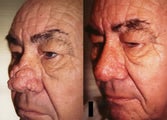 Rhinophyma