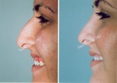 Rhinoplasty