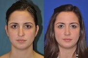Rhinoplasty