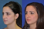 Rhinoplasty