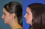 Rhinoplasty