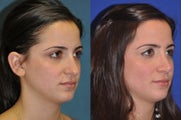 Rhinoplasty