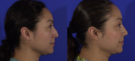 Rhinoplasty