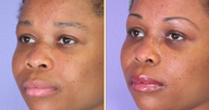 Nose Reshaping