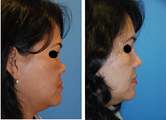 Rhinoplasty with Medpor