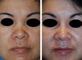 Rhinoplasty