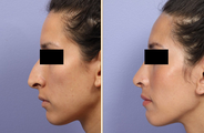 Rhinoplasty