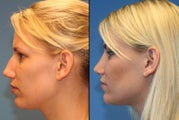 rhinoplasty