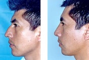 Rhinoplasty