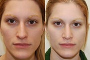 Rhinoplasty Surgery. 4 months post-op. Frontal view.