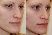 Rhinoplasty Surgery. 4 months post-op. 3/4 view.
