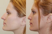Rhinoplasty Surgery. 4 months post-op. Profile view.
