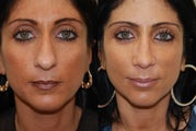 Rhinoplasty Surgery. I year post-op