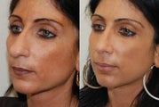 Rhinoplasty Surgery. 1 year post-op.