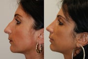 Rhinoplasty Surgery. 1 year post-op.