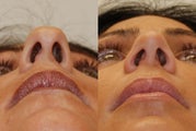 Rhinoplasty Surgery. 1 year post-op