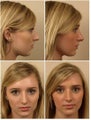 Rhinoplasty
