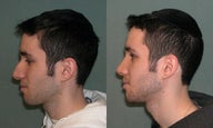Rhinoplasty