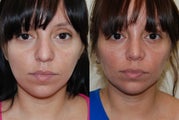 Rhinoplasty Surgery. 4 months post-op.