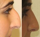 Rhinoplasty