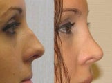 Rhinoplasty