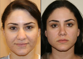 Ethnic Rhinoplasty