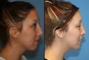 Teen rhinoplasty